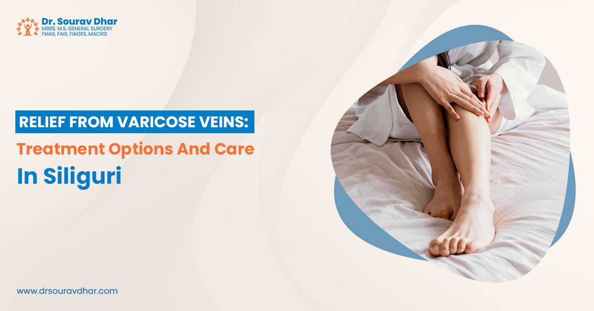 varicose veins in Siliguri