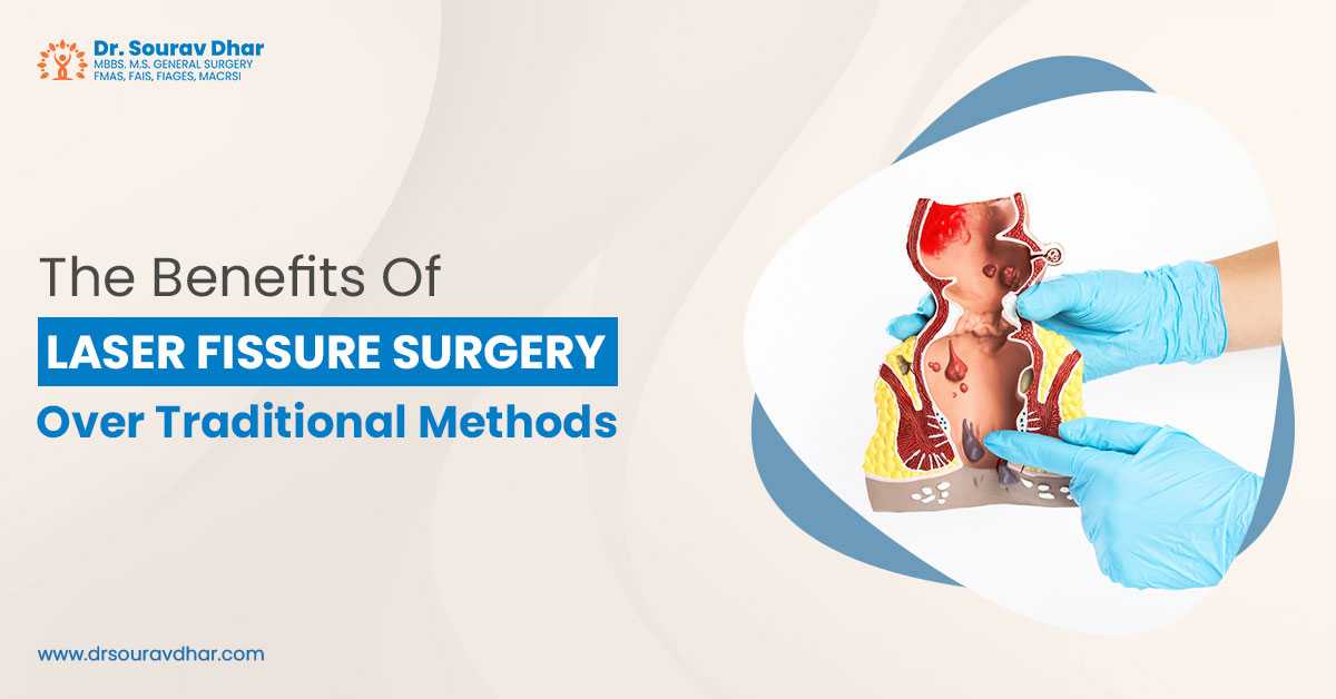 Laser Fissure surgery in Siliguri