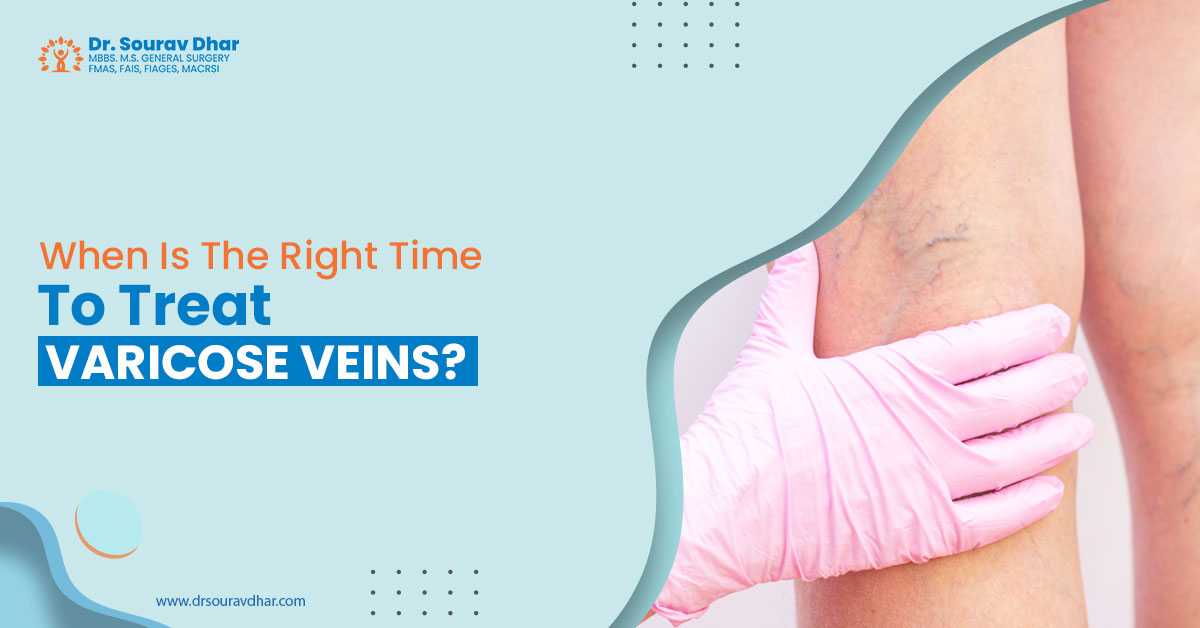 varicose veins in Siliguri