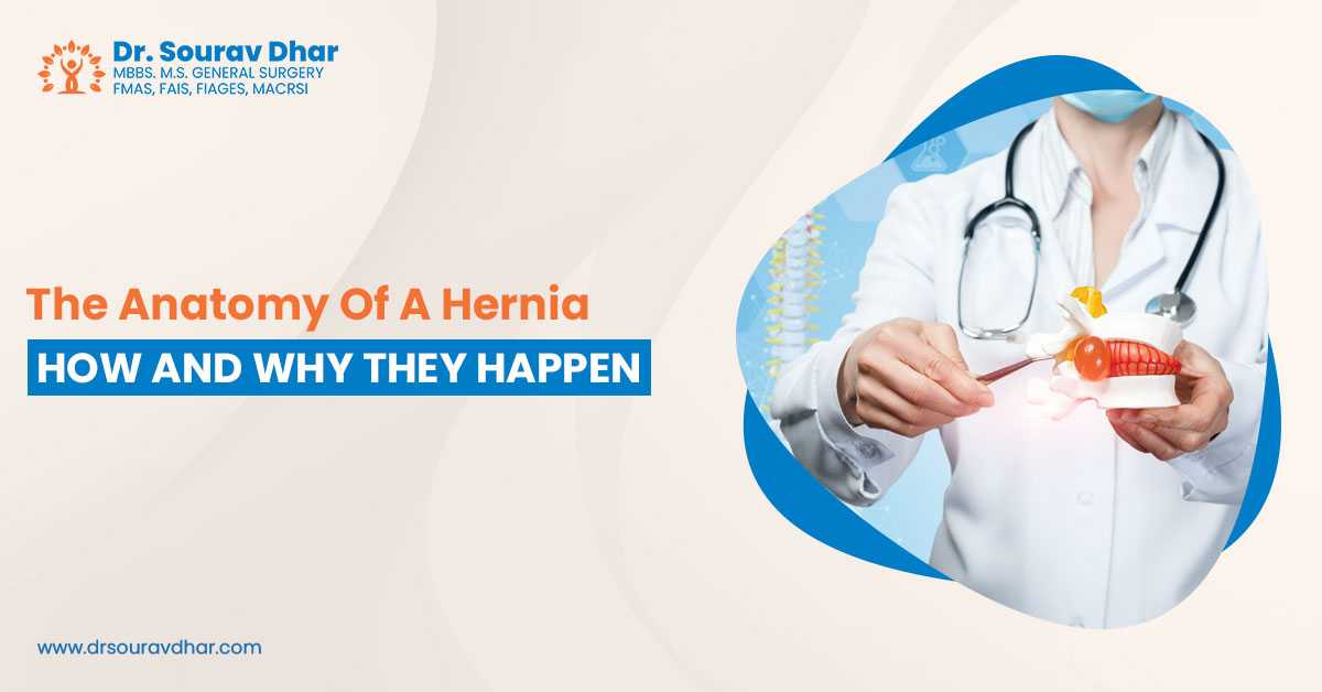 Hernia Surgery in Siliguri