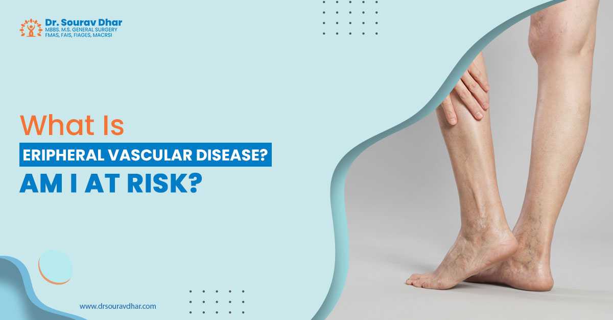 varicose veins in Siliguri